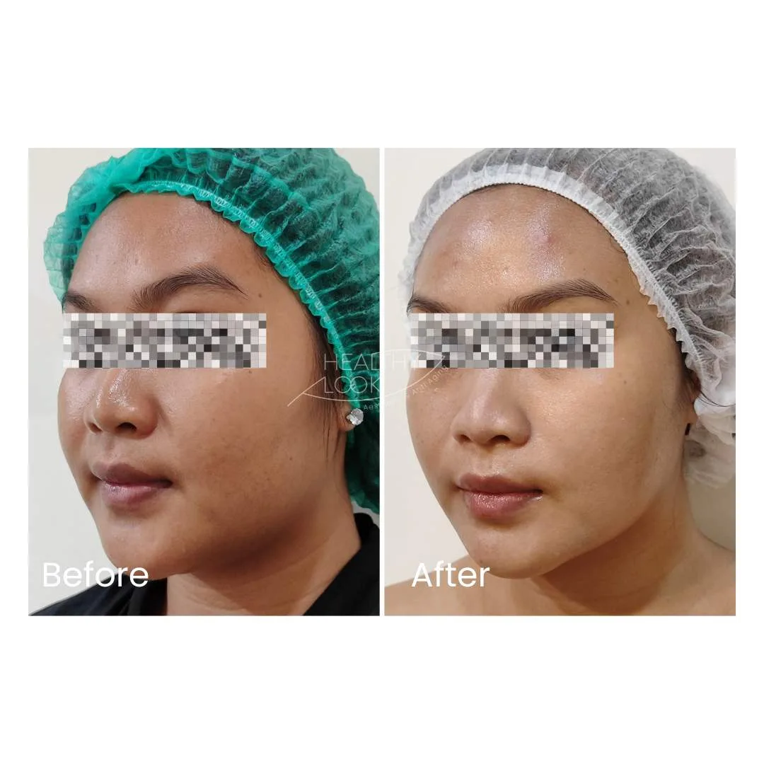 before after treatment